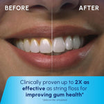 Before and after comparison of teeth whitening and improved gum health.