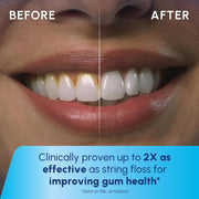 Before and after comparison of teeth whitening and improved gum health.